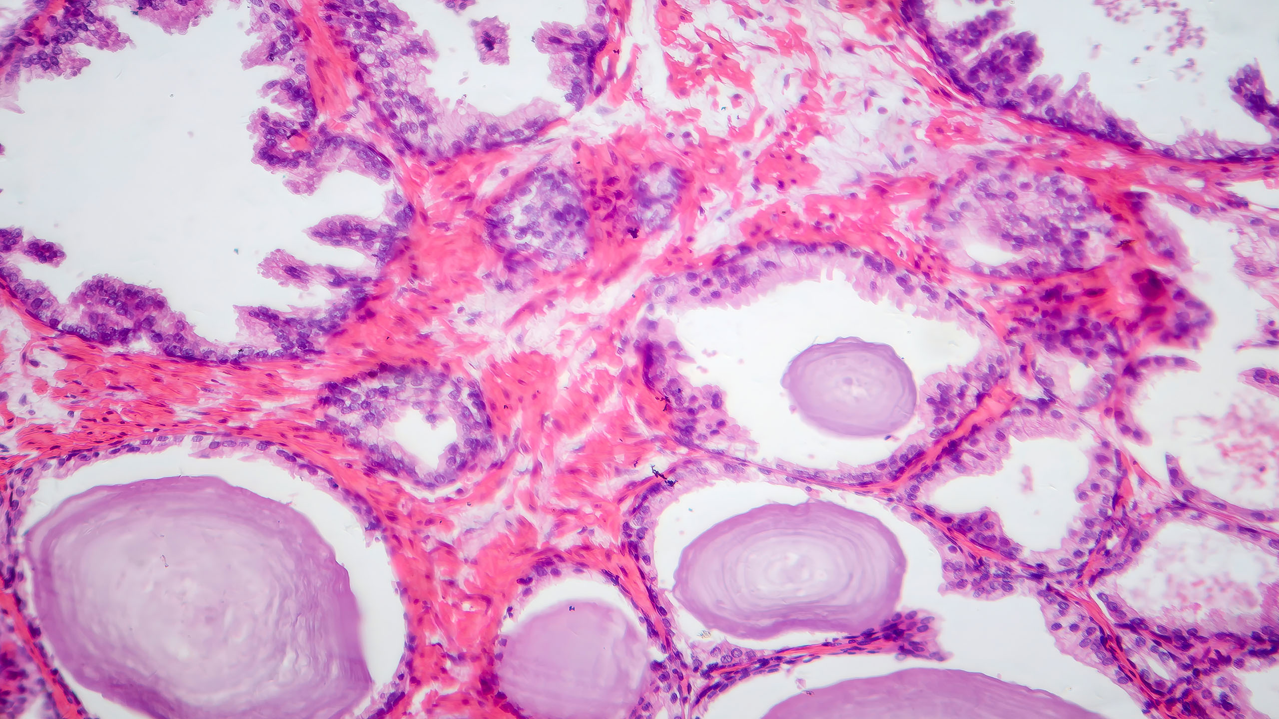 Gutartige Prostatavergrößerung (BPH) - Mikroskopische Gewebedarstellung. Urologenzentrum Wien - Gutartige Prostatavergrößerung (BPH): Mikroskopische Darstellung des Gewebes einer vergrößerten Prostata.